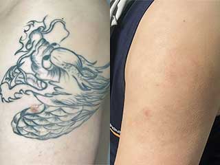 花臂纹身清洗前后对比案例
